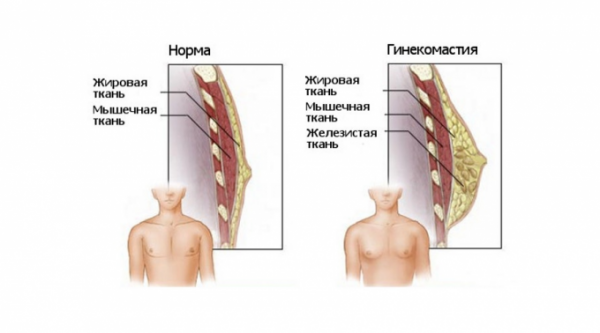 Гинекомастия не порок!