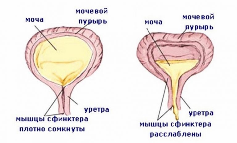 Опущение мочевого пузыря