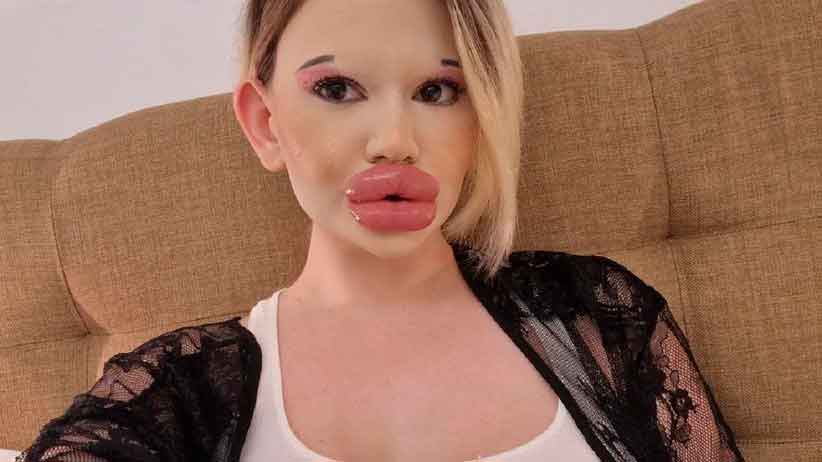 У этой женщины «самые большие губы в мире»