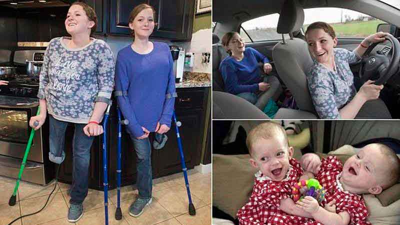 Врачи разлучили сиамских сестер 20 лет назад. Одна из них родила дочь в той же больнице